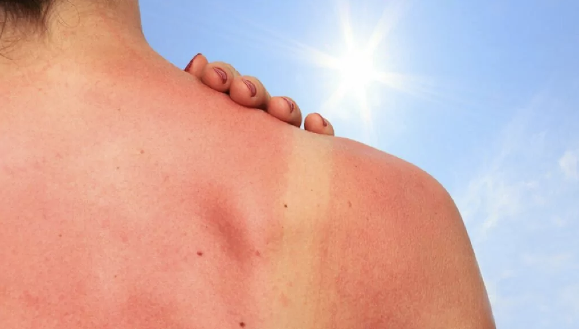 Soleil et cancer : ce qu’on ne vous dit jamais